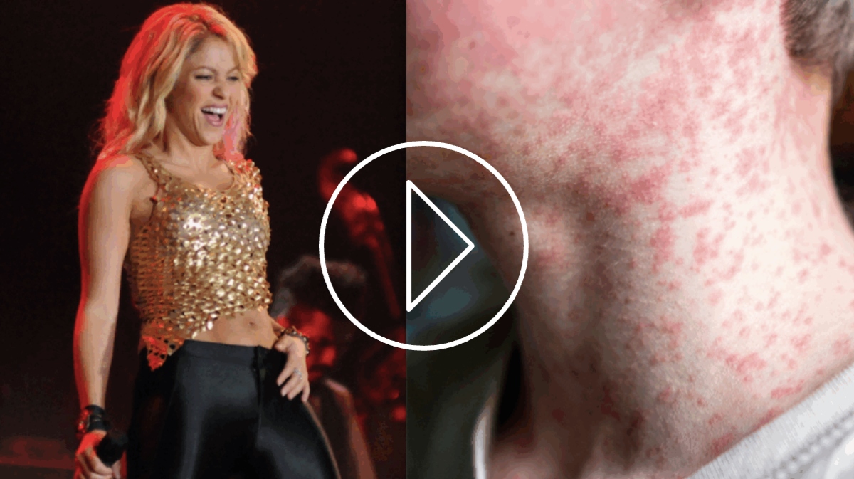 Alerta por brote de sarampión en concierto de Shakira
