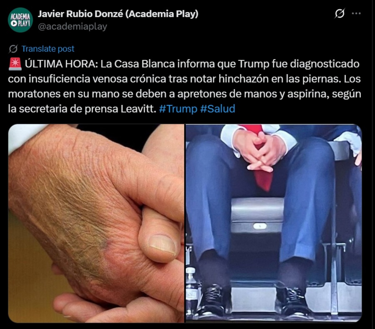 Donald Trump salud