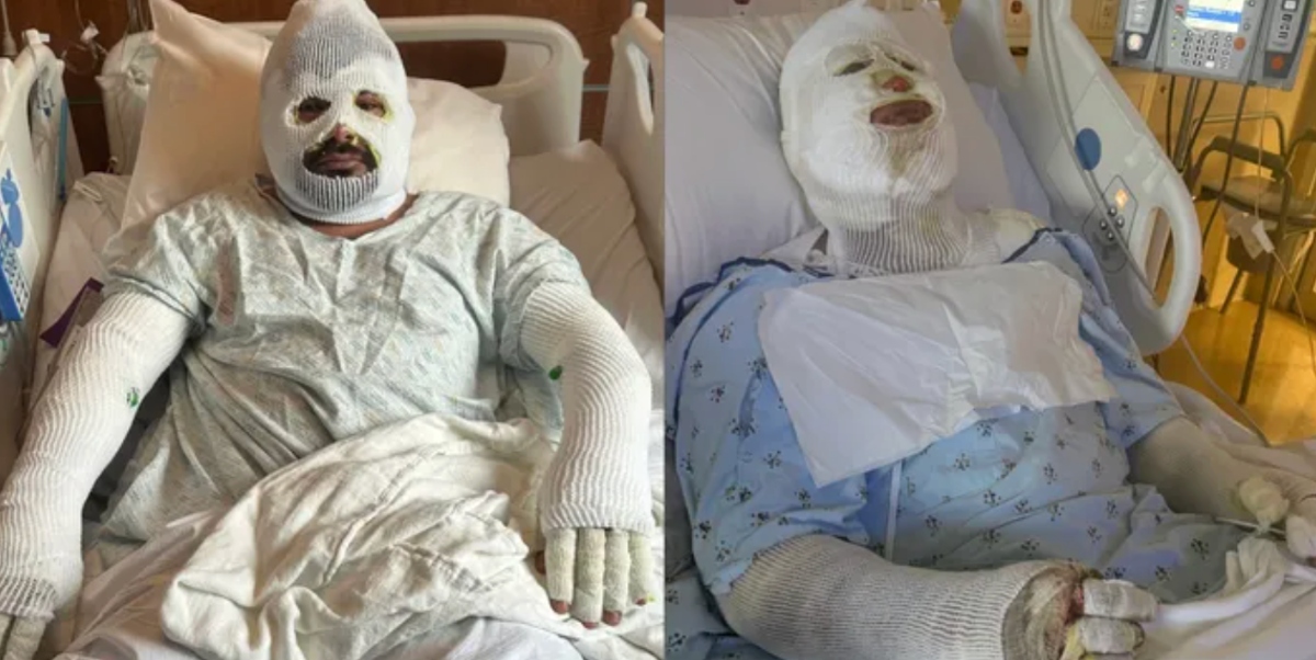 Accidente laboral en Georgia deja a dos hispanos con graves quemaduras