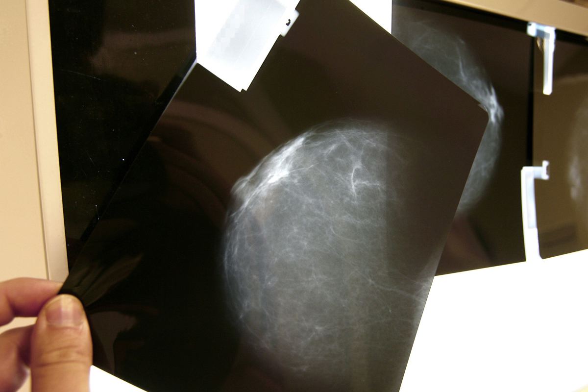 Investigación descubre cómo las células senescentes influyen en el cáncer de mama