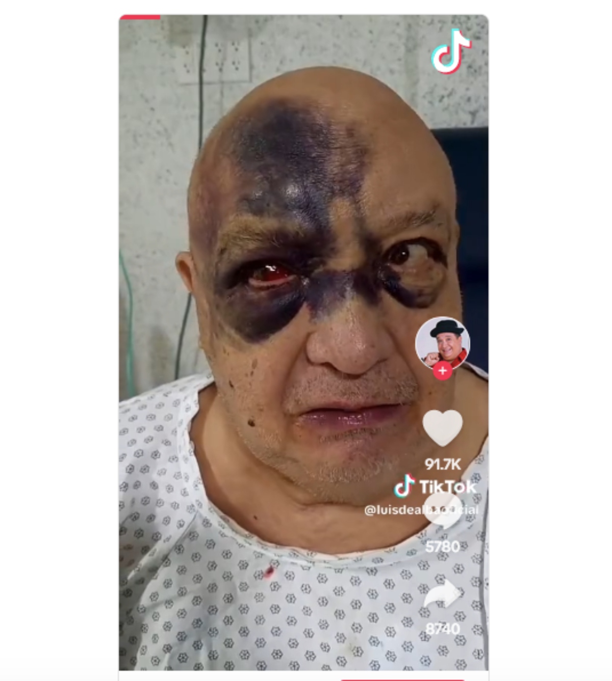 Luis de Alba aparece lleno de moretones video causando alarma